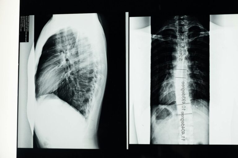 Osteoporose und Wirbelfrakturen: Symptome und Behandlung High-resolution X-ray showing a detailed examination of human spine with scoliosis.