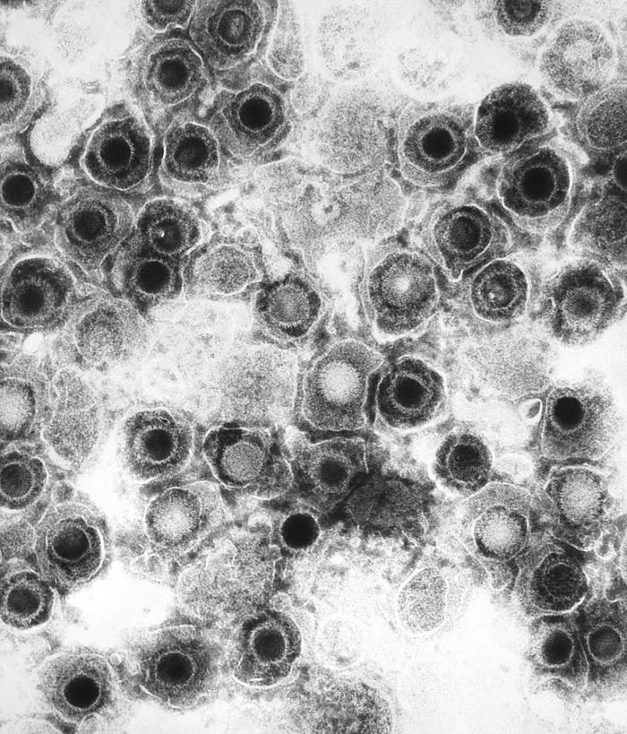 Zoster-Enzephalitis