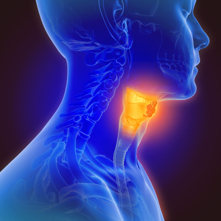 Bösartige Neubildungen des Oropharynx