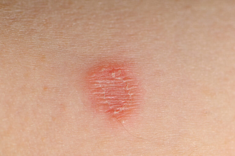 Tinea Corporis