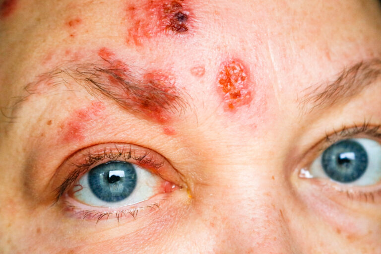 Zoster Ophthalmicus