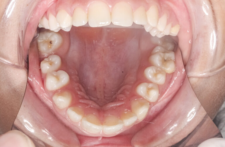 Vesikuläre Pharyngitis durch Enteroviren