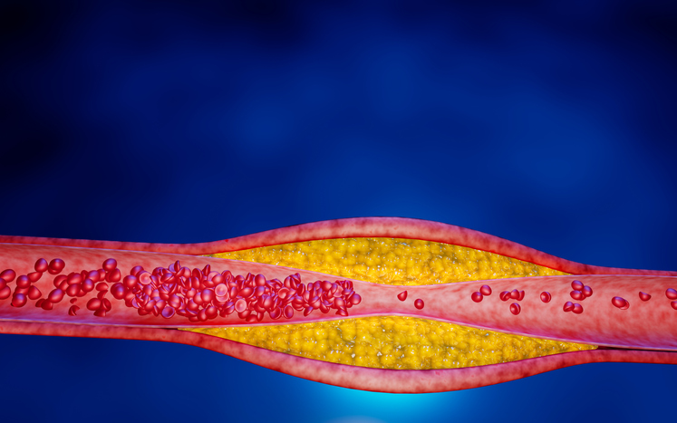 Hyperlipidämie (hoher Cholesterinspiegel)