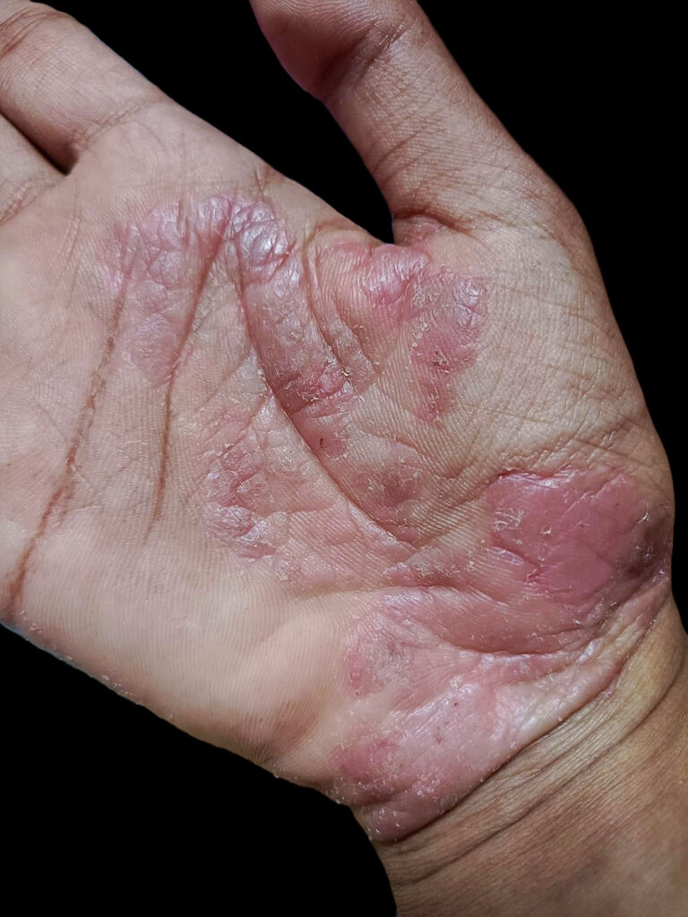 Tinea Manuum