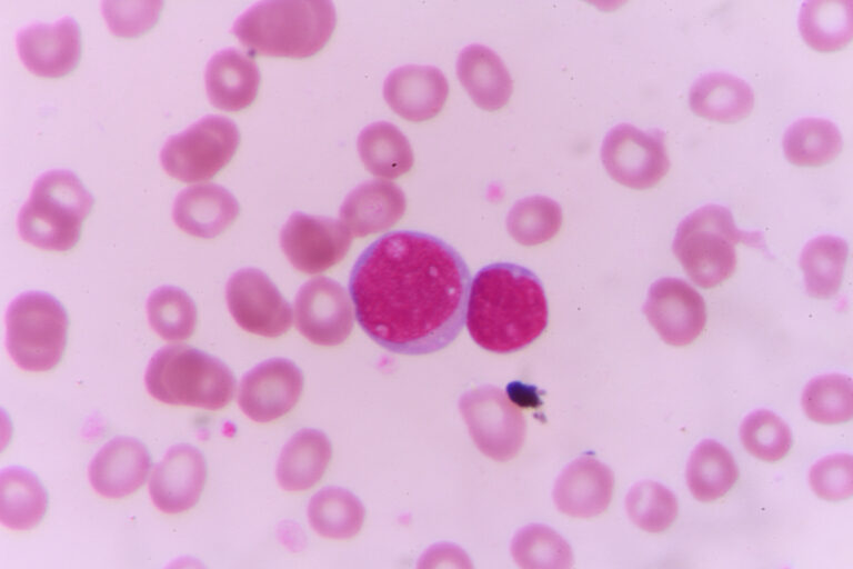 Chronische intestinale Amöbiasis