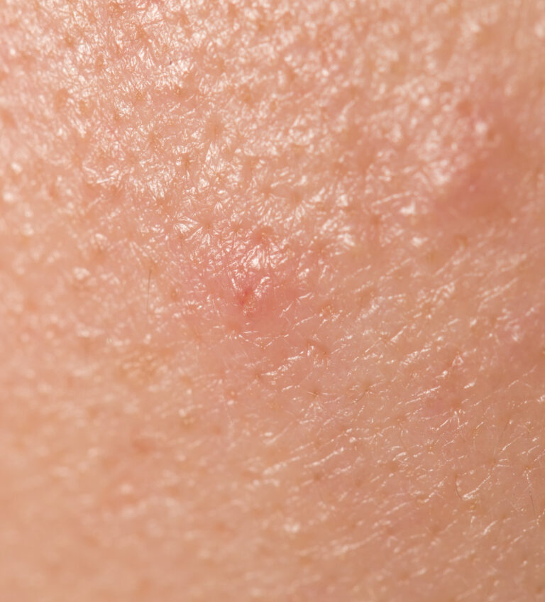Tinea Nigra