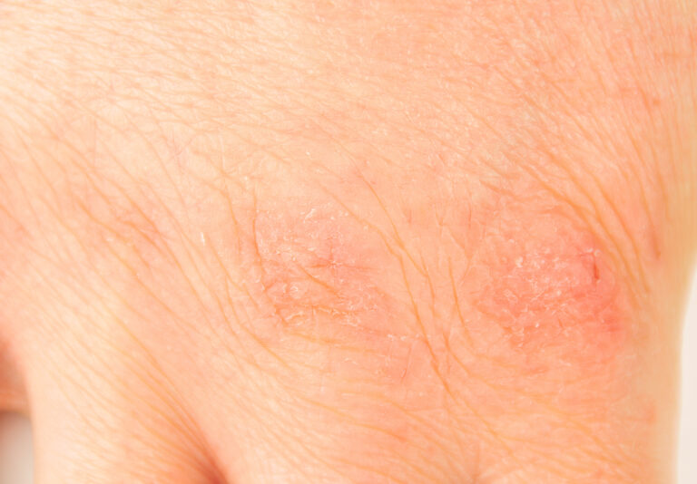 Mansonelliasis