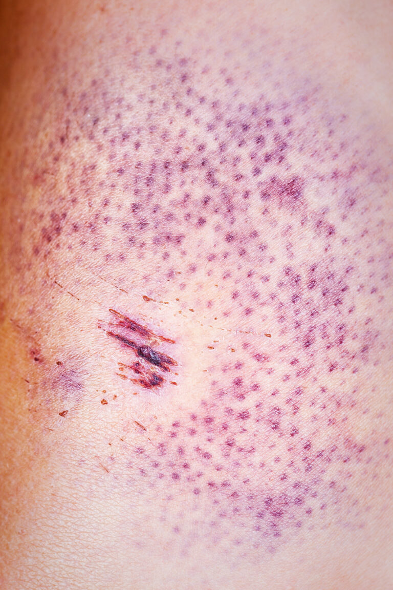Dirofilariose