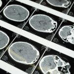 Detailed brain MRI scans displayed on a lightbox, showcasing medical imaging techniques.
