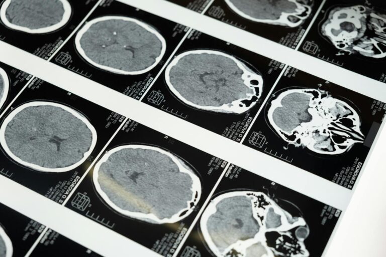 Lewy-Körper-Krankheit Detailed brain MRI scans displayed on a lightbox, showcasing medical imaging techniques.