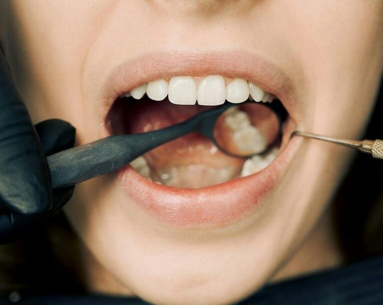 Aktinomykose Close-up of a dental examination with modern equipment, showcasing oral hygiene maintenance.