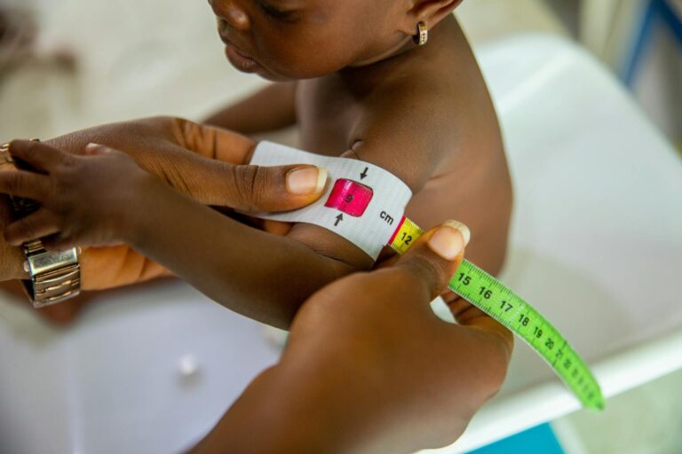 Kwashiorkor A healthcare professional measures a child's arm using MUAC tape for malnutrition assessment.