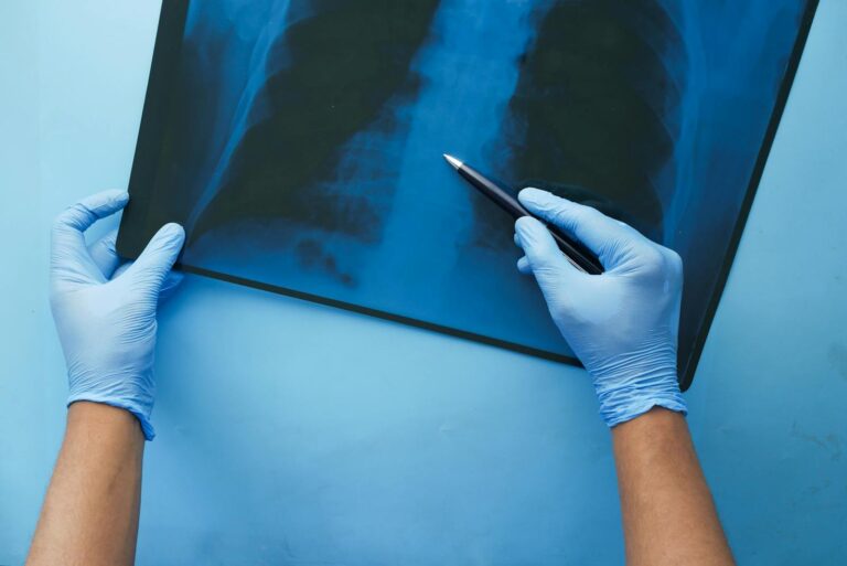 Lungentuberkulose A doctor in blue gloves examines a chest x-ray with a pen, focusing on medical diagnosis.